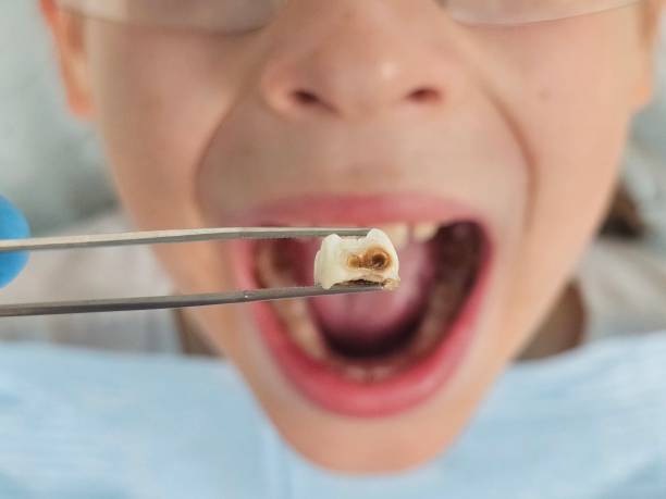 Best Emergency Wisdom Teeth Removal in Walcott, IA